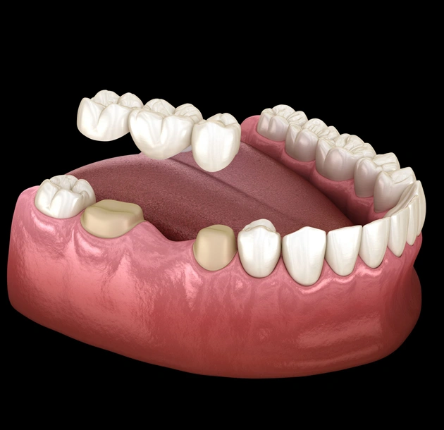 Dental implant model showing tooth replacement procedure with crowns and implants in jawbone.