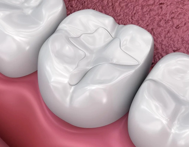 3D dental model showing tooth restoration on pink gum surface for cosmetic dentistry illustration.