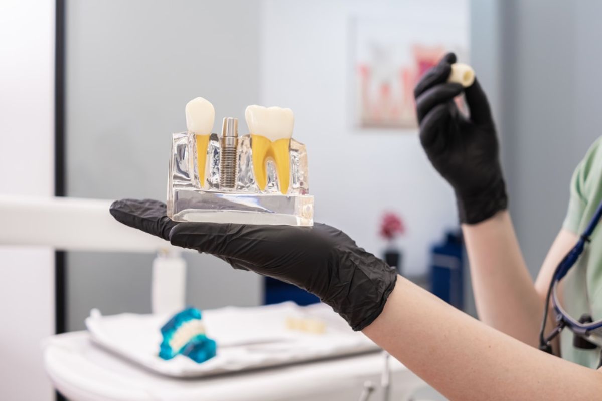 Dental Implants in Silver Spring