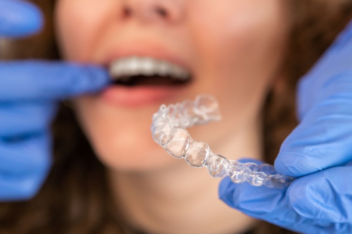 Important Things You Should Know Before Getting Invisalign Treatment