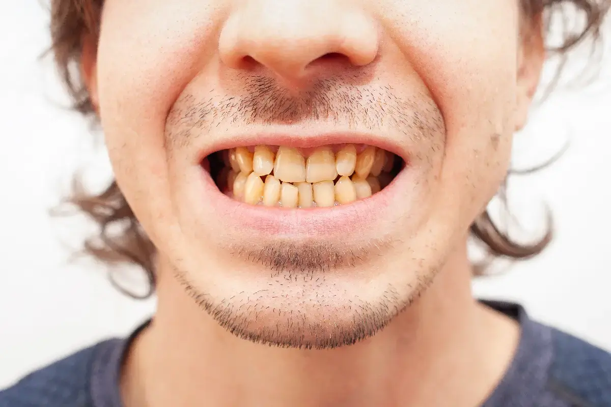 Man with yellow stained teeth smiling, demonstrating tooth discoloration before natural whitening treatment.